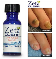 Zetaclear nail fungus treatment - Reviews 