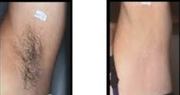 LASER HAIR REMOVAL BY: XTREMELASHCANADA