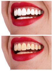 TEETH WHITENING BY XTREMELASHCANADA