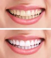 Professional Teeth Whitening Certificate in Toronto