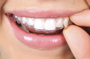 Buy Clear Aligners Online at Home With Pure Smiles Online
