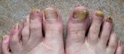 Antifungal Foot Care Serum New - https://tinyurl.com/fhtdc8w
